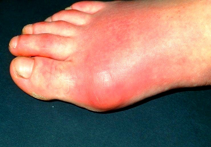 What Causes Gout Pain