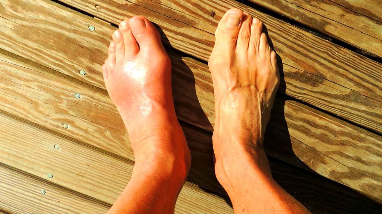 What Causes Gout Pain