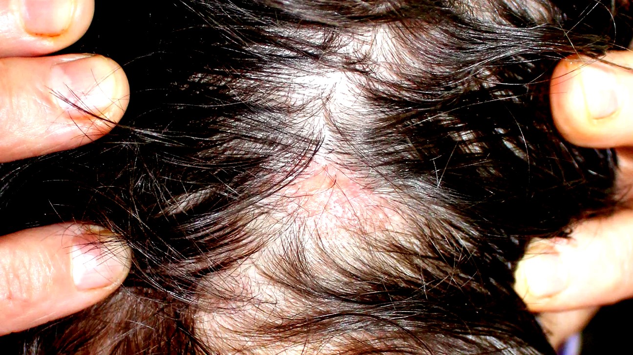 How to Diagnose Alopecia